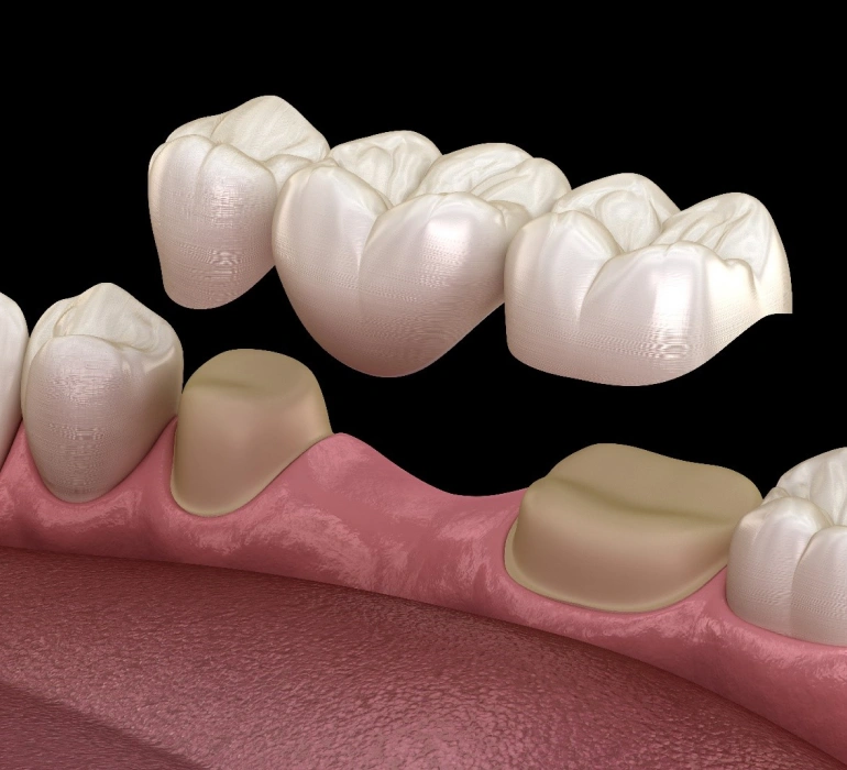 customized dental crowns and bridges solution in Chicago, il