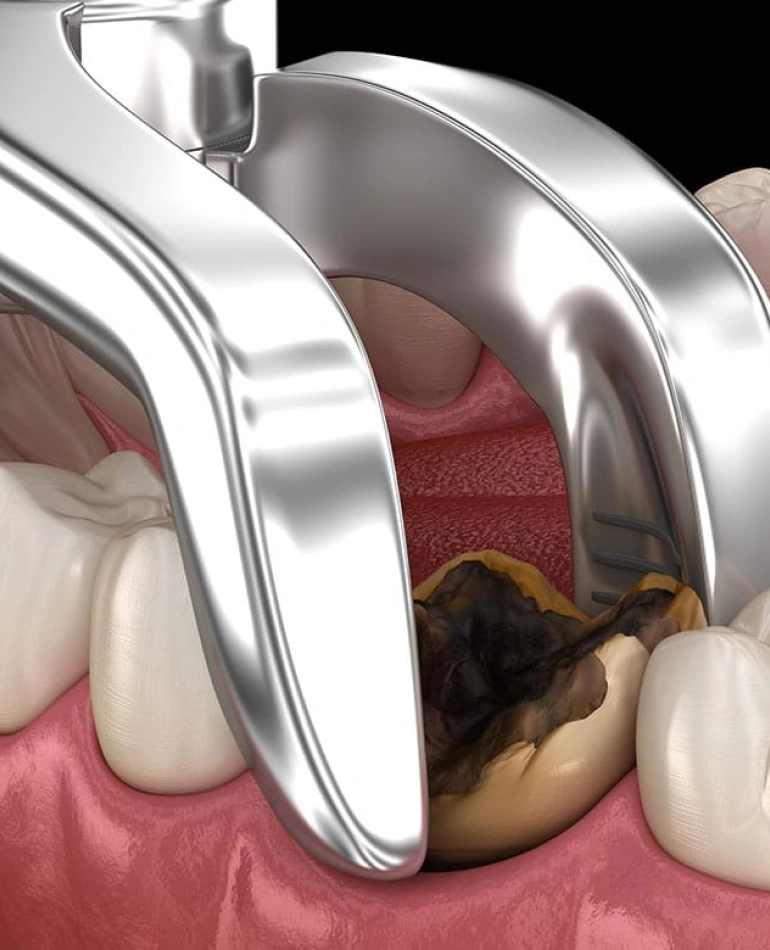 tooth-extractions-in-chicago-il